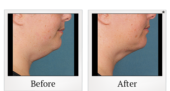 Before and After Photo 3 of Kybella® treatment at SF Bay Cosmetic Surgery Medical Group in San Ramon