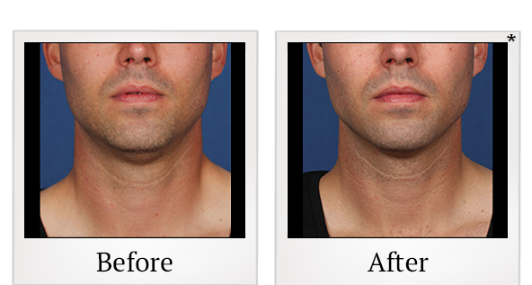Before and After Photo 4 of Kybella® treatment at SF Bay Cosmetic Surgery Medical Group in San Ramon