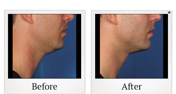 Before and After Photo 5 of Kybella® treatment at SF Bay Cosmetic Surgery Medical Group in San Ramon