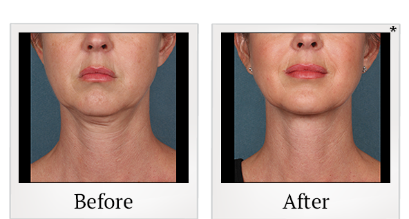 Before and After Photo 6 of Kybella® treatment at SF Bay Cosmetic Surgery Medical Group in San Ramon