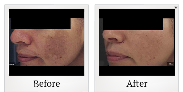 Before and After Photo 1 of LaserGenesis® treatment at SF Bay Cosmetic Surgery Medical Group in San Ramon
