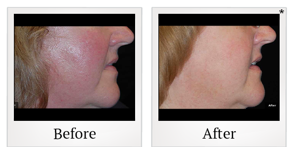 Before and After Photo 2 of LaserGenesis® treatment at SF Bay Cosmetic Surgery Medical Group in San Ramon
