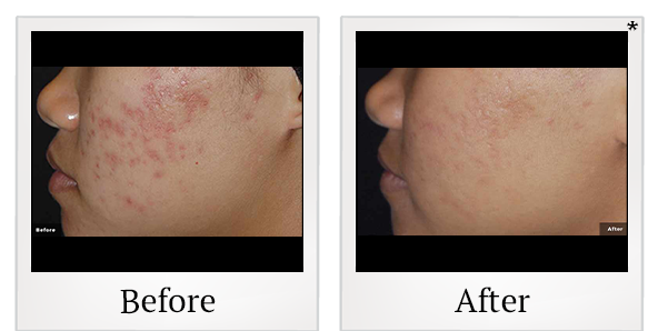 Before and After Photo 3 of LaserGenesis® treatment at SF Bay Cosmetic Surgery Medical Group in San Ramon