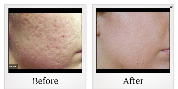 Before and After Photo 4 of LaserGenesis® treatment at SF Bay Cosmetic Surgery Medical Group in San Ramon