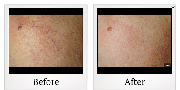 Before and After Photo 5 of LaserGenesis® treatment at SF Bay Cosmetic Surgery Medical Group in San Ramon