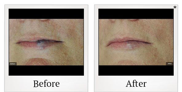 Before and After Photo 6 of LaserGenesis® treatment at SF Bay Cosmetic Surgery Medical Group in San Ramon