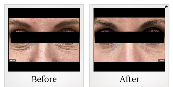 Before and After Photo 7 of LaserGenesis® treatment at SF Bay Cosmetic Surgery Medical Group in San Ramon