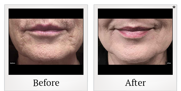 Before and After Photo 8 of LaserGenesis® treatment at SF Bay Cosmetic Surgery Medical Group in San Ramon