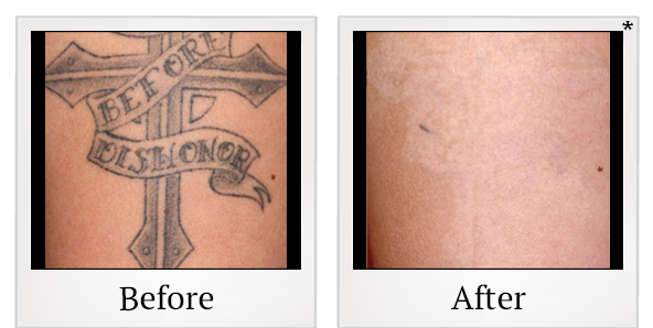Before and After Photo 1 of Laser Tattoo Removal treatment at SF Bay Cosmetic Surgery Medical Group in San Ramon