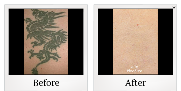 Before and After Photo 2 of Laser Tattoo Removal treatment at SF Bay Cosmetic Surgery Medical Group in San Ramon