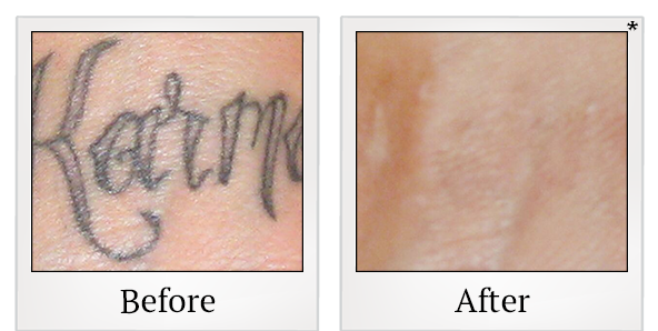 Before and After Photo 3 of Laser Tattoo Removal treatment at SF Bay Cosmetic Surgery Medical Group in San Ramon