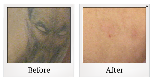 Before and After Photo 4 of Laser Tattoo Removal treatment at SF Bay Cosmetic Surgery Medical Group in San Ramon