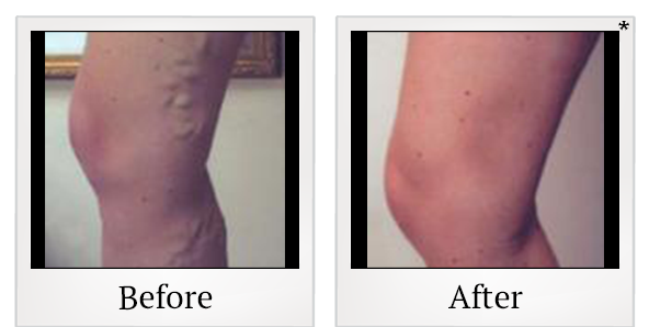 Before and After Photo 1 of Laser Vein Therapy treatment at SF Bay Cosmetic Surgery Medical Group in San Ramon