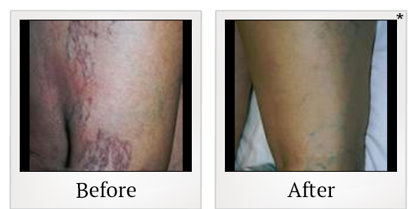 Before and After Photo 2 of Laser Vein Therapy treatment at SF Bay Cosmetic Surgery Medical Group in San Ramon