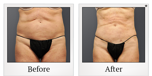 Before and After Photo 1 of Smartlipo® & Lipo treatment at SF Bay Cosmetic Surgery Medical Group in San Ramon