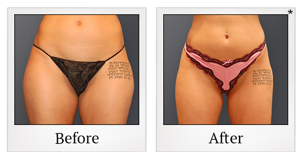 Before and After Photo 10 of Smartlipo® & Lipo treatment at SF Bay Cosmetic Surgery Medical Group in San Ramon