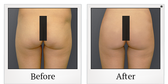 Before and After Photo 11 of Smartlipo® & Lipo treatment at SF Bay Cosmetic Surgery Medical Group in San Ramon