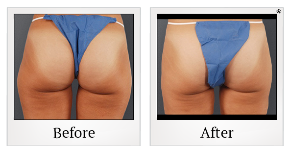Before and After Photo 12 of Smartlipo® & Lipo treatment at SF Bay Cosmetic Surgery Medical Group in San Ramon