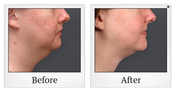 Before and After Photo 13 of Smartlipo® & Lipo treatment at SF Bay Cosmetic Surgery Medical Group in San Ramon