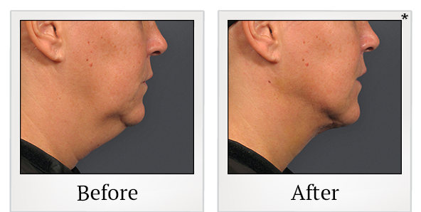 Before and After Photo 14 of Smartlipo® & Lipo treatment at SF Bay Cosmetic Surgery Medical Group in San Ramon