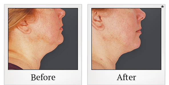 Before and After Photo 15 of Smartlipo® & Lipo treatment at SF Bay Cosmetic Surgery Medical Group in San Ramon