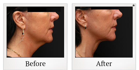 Before and After Photo 16 of Smartlipo® & Lipo treatment at SF Bay Cosmetic Surgery Medical Group in San Ramon