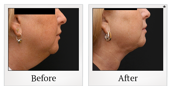 Before and After Photo 17 of Smartlipo® & Lipo treatment at SF Bay Cosmetic Surgery Medical Group in San Ramon