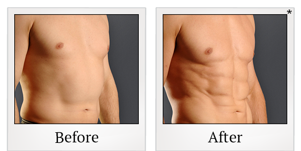 Before and After Photo 2 of Smartlipo® & Lipo treatment at SF Bay Cosmetic Surgery Medical Group in San Ramon