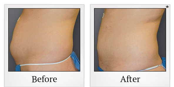 Before and After Photo 3 of Smartlipo® & Lipo treatment at SF Bay Cosmetic Surgery Medical Group in San Ramon