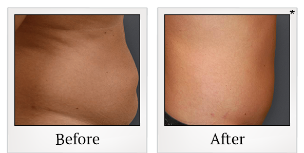Before and After Photo 4 of Smartlipo® & Lipo treatment at SF Bay Cosmetic Surgery Medical Group in San Ramon