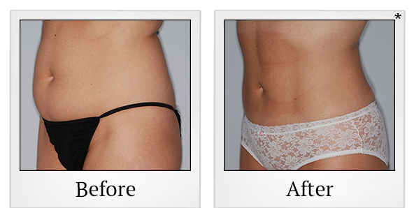 Before and After Photo 5 of Smartlipo® & Lipo treatment at SF Bay Cosmetic Surgery Medical Group in San Ramon