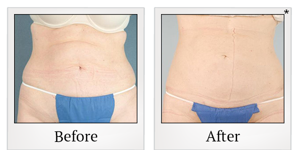Before and After Photo 6 of Smartlipo® & Lipo treatment at SF Bay Cosmetic Surgery Medical Group in San Ramon