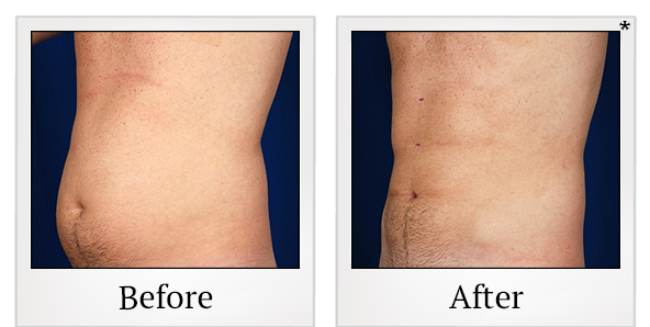 Before and After Photo 7 of Smartlipo® & Lipo treatment at SF Bay Cosmetic Surgery Medical Group in San Ramon
