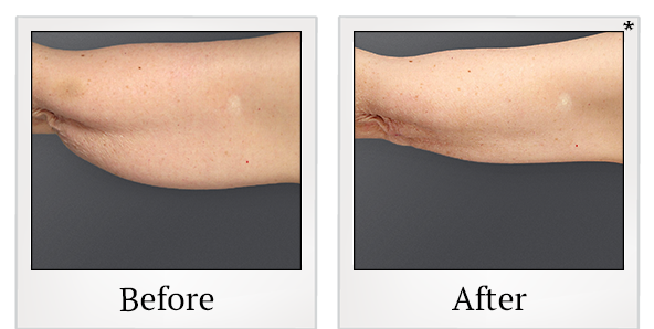 Before and After Photo 8 of Smartlipo® & Lipo treatment at SF Bay Cosmetic Surgery Medical Group in San Ramon