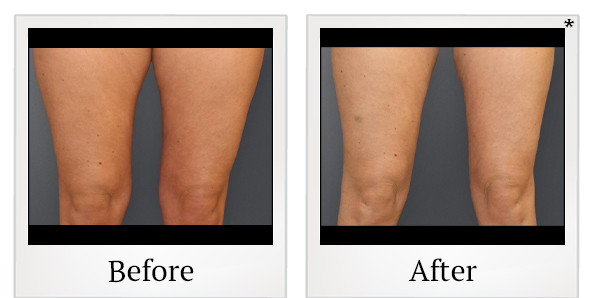 Before and After Photo 9 of Smartlipo® & Lipo treatment at SF Bay Cosmetic Surgery Medical Group in San Ramon