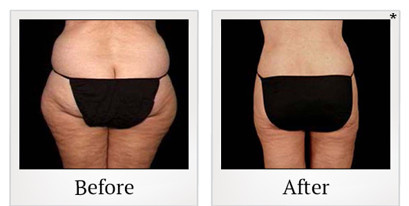 Before and After Photo 1 of Smartlipo® & Lipo treatment at SF Bay Cosmetic Surgery Medical Group in San Ramon