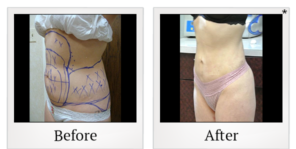 Before and After Photo 10 of Smartlipo® & Lipo treatment at SF Bay Cosmetic Surgery Medical Group in San Ramon