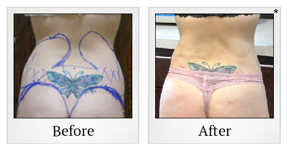 Before and After Photo 11 of Smartlipo® & Lipo treatment at SF Bay Cosmetic Surgery Medical Group in San Ramon