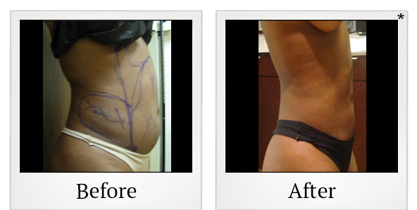 Before and After Photo 12 of Smartlipo® & Lipo treatment at SF Bay Cosmetic Surgery Medical Group in San Ramon