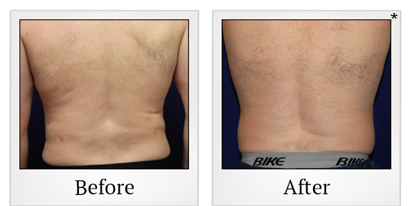 Before and After Photo 13 of Smartlipo® & Lipo treatment at SF Bay Cosmetic Surgery Medical Group in San Ramon