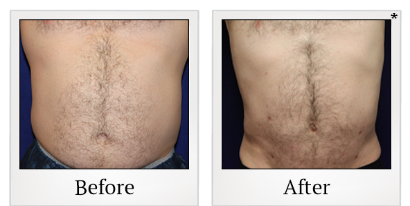 Before and After Photo 14 of Smartlipo® & Lipo treatment at SF Bay Cosmetic Surgery Medical Group in San Ramon