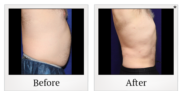 Before and After Photo 15 of Smartlipo® & Lipo treatment at SF Bay Cosmetic Surgery Medical Group in San Ramon