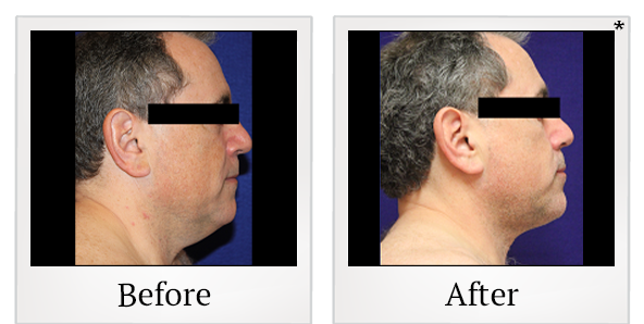 Before and After Photo 16 of Smartlipo® & Lipo treatment at SF Bay Cosmetic Surgery Medical Group in San Ramon