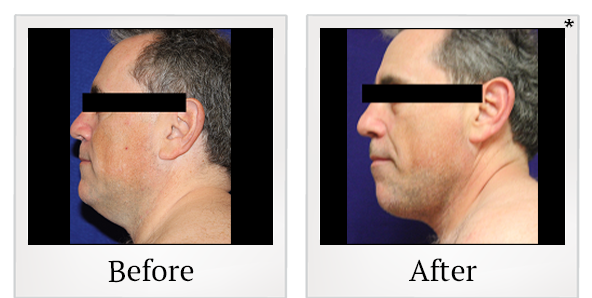 Before and After Photo 17 of Smartlipo® & Lipo treatment at SF Bay Cosmetic Surgery Medical Group in San Ramon