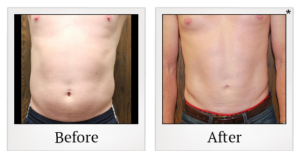 Before and After Photo 18 of Smartlipo® & Lipo treatment at SF Bay Cosmetic Surgery Medical Group in San Ramon