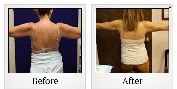 Before and After Photo 19 of Smartlipo® & Lipo treatment at SF Bay Cosmetic Surgery Medical Group in San Ramon