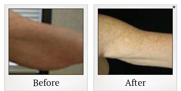 Before and After Photo 2 of Smartlipo® & Lipo treatment at SF Bay Cosmetic Surgery Medical Group in San Ramon