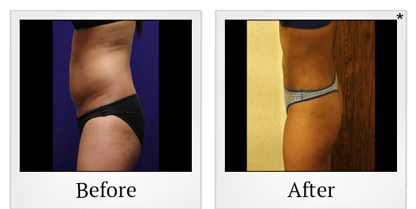 Before and After Photo 20 of Smartlipo® & Lipo treatment at SF Bay Cosmetic Surgery Medical Group in San Ramon