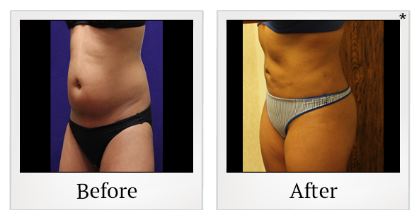 Before and After Photo 12 of Smartlipo® & Lipo treatment at SF Bay Cosmetic Surgery Medical Group in San Ramon