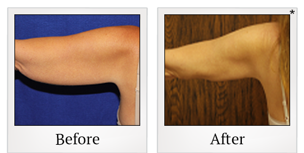 Before and After Photo 22 of Smartlipo® & Lipo treatment at SF Bay Cosmetic Surgery Medical Group in San Ramon